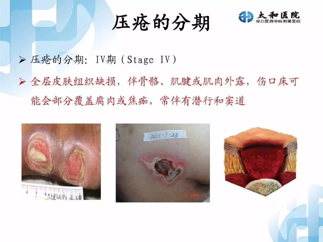 压疮分级最新标准解析